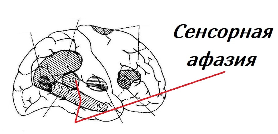 Схема нарушения мозга при сенсорной афазии